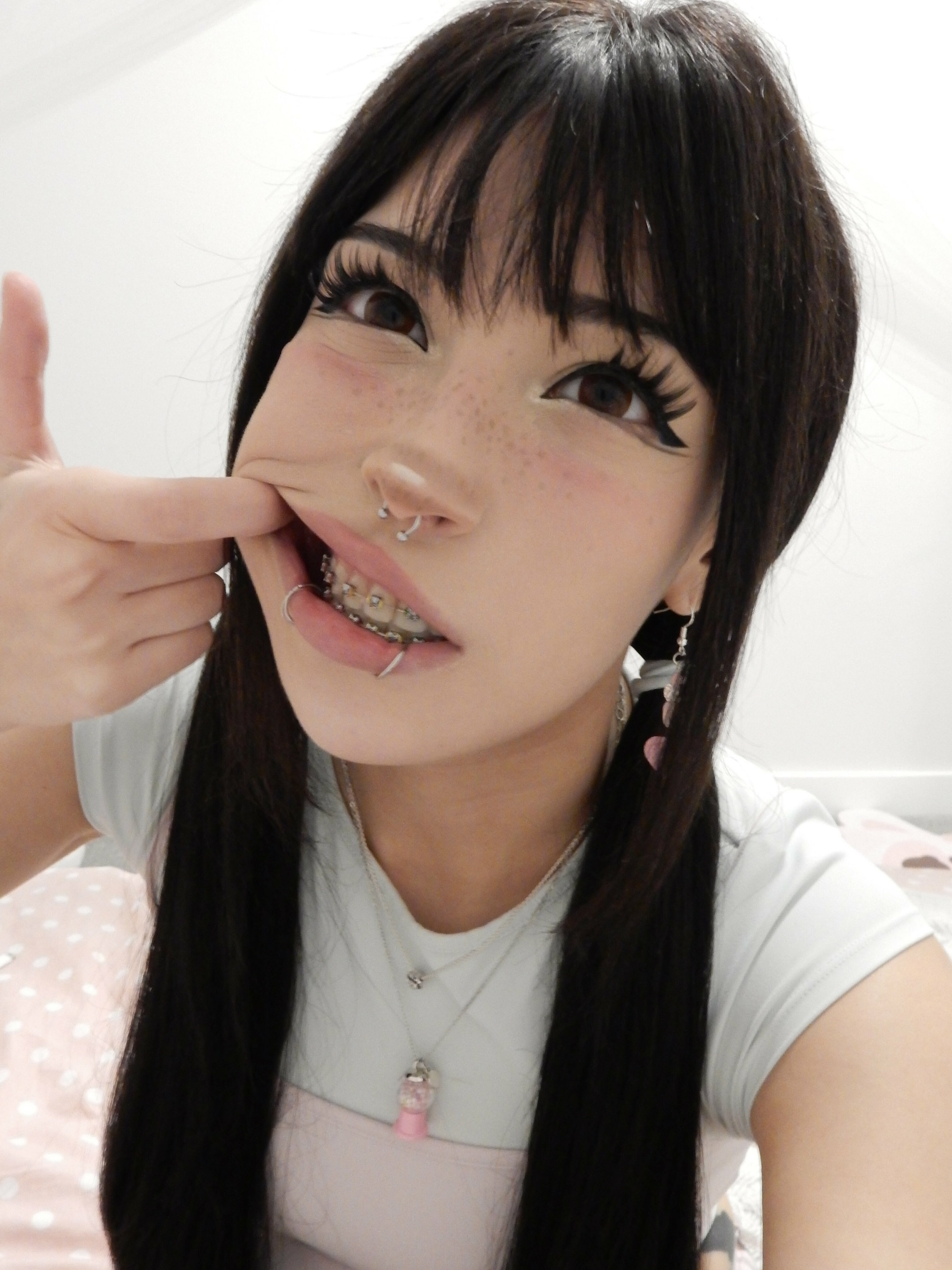 Braces — 10