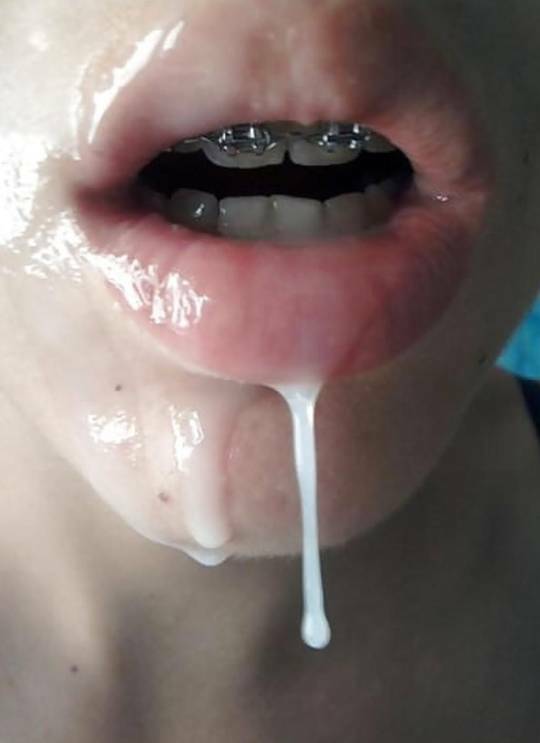 Brace faces — 10
