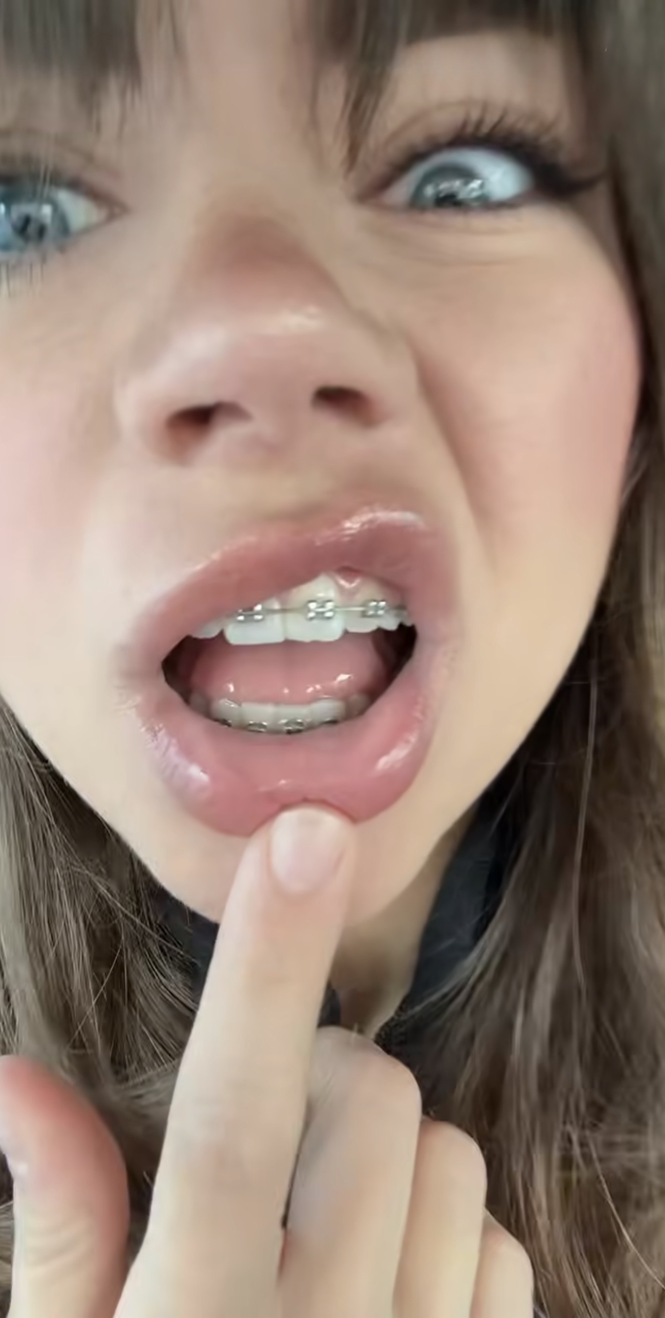 Braces! — 40