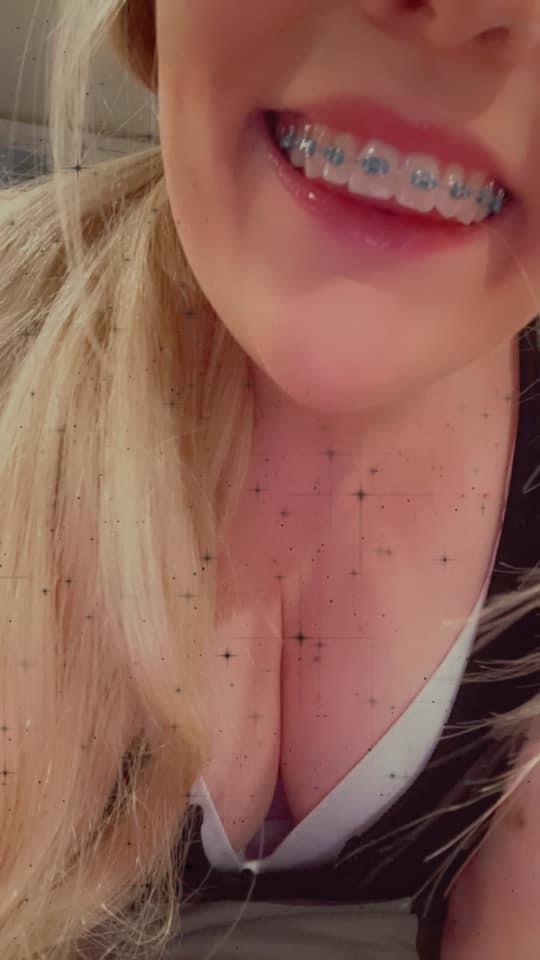 Brace faces — 15