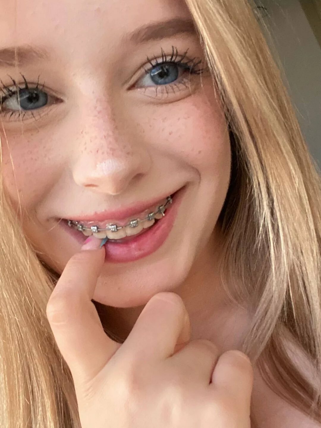 Braces! — 14