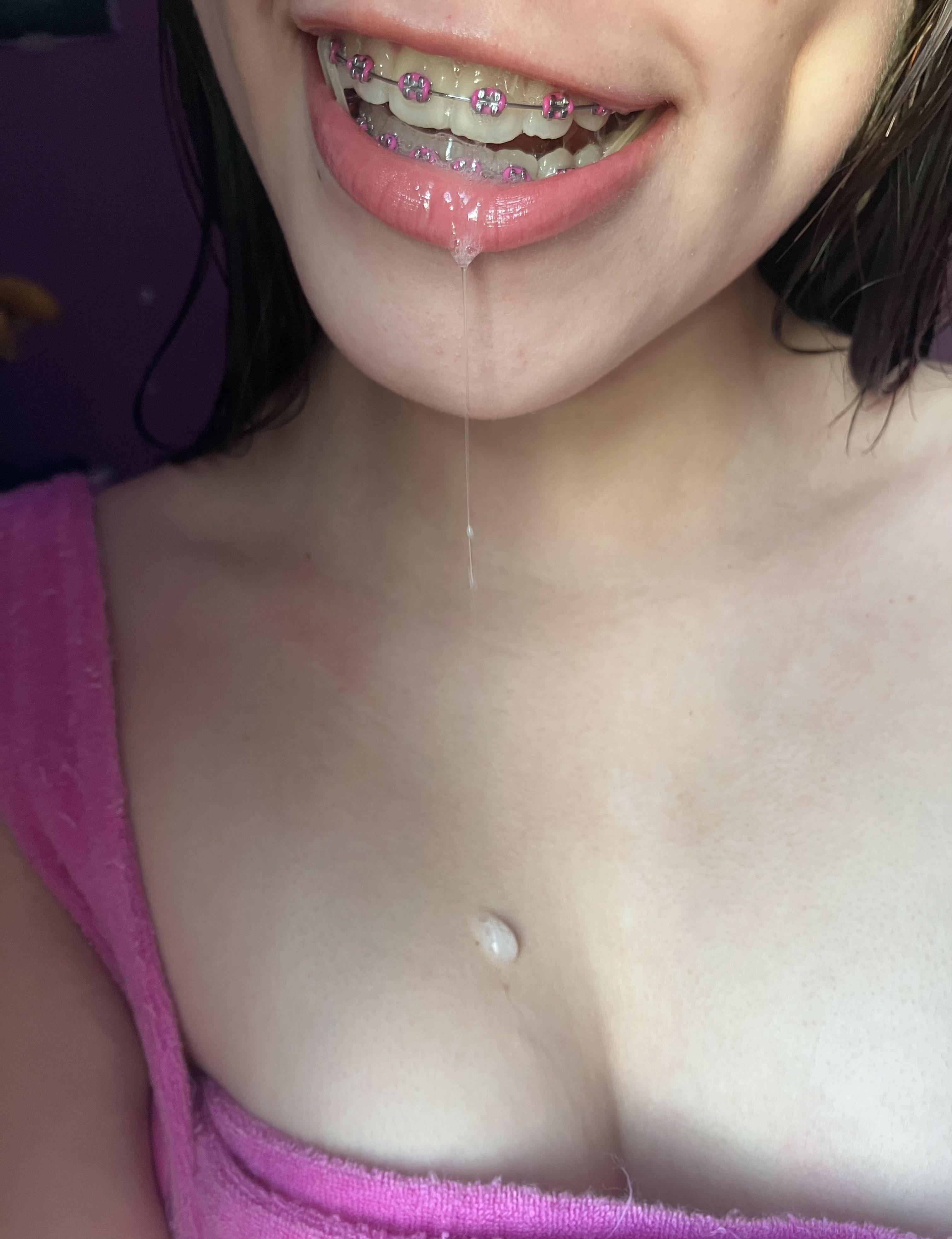 Braces! — 24