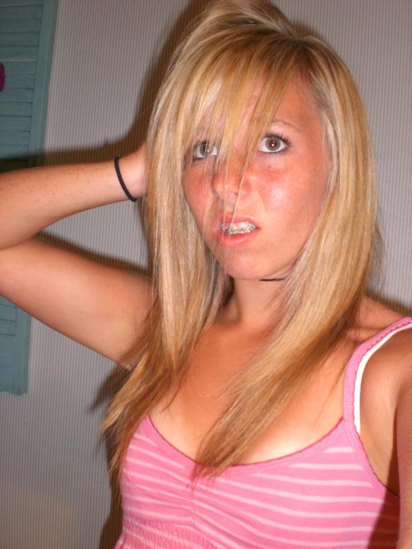 Braces — 17