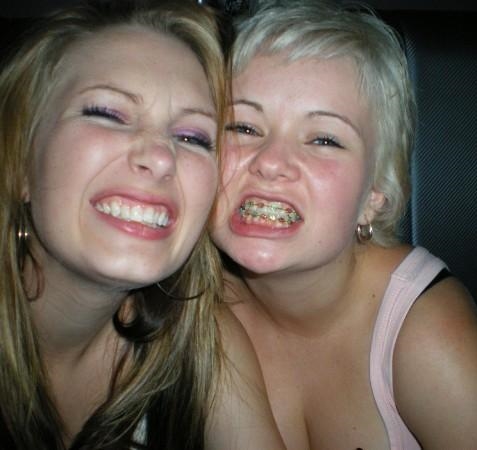 Braces — 21