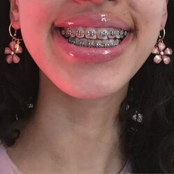 Braces! — 56